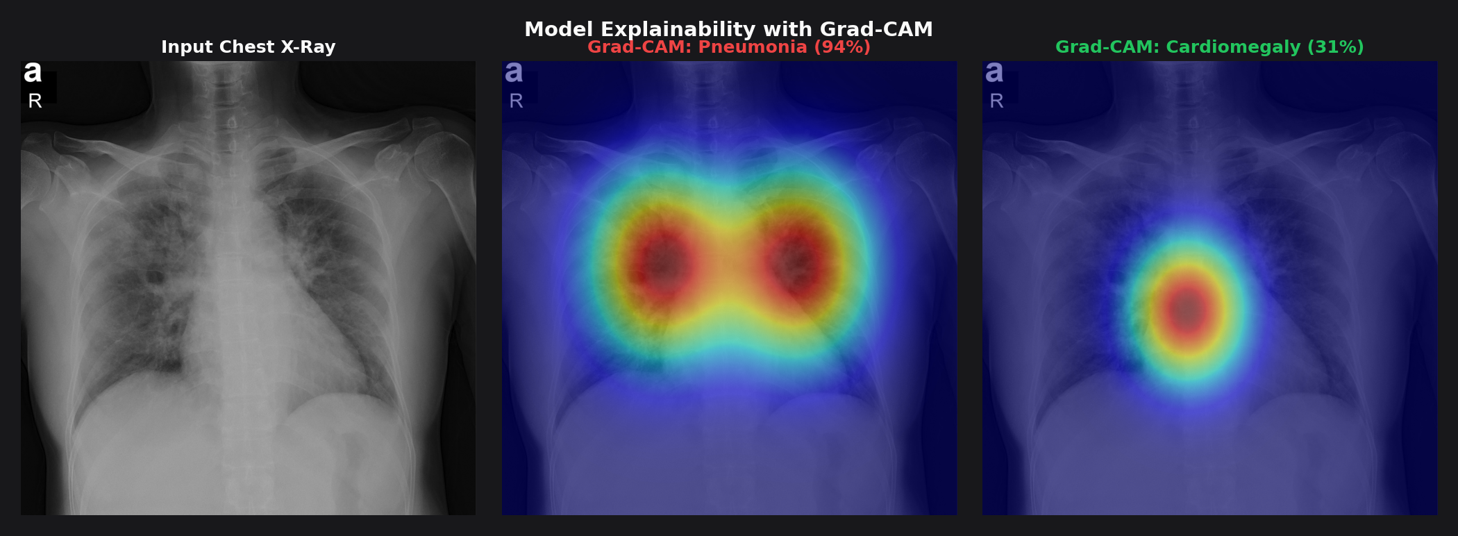 Grad-CAM visualization showing model attention for Pneumonia and Cardiomegaly detection on real chest X-ray