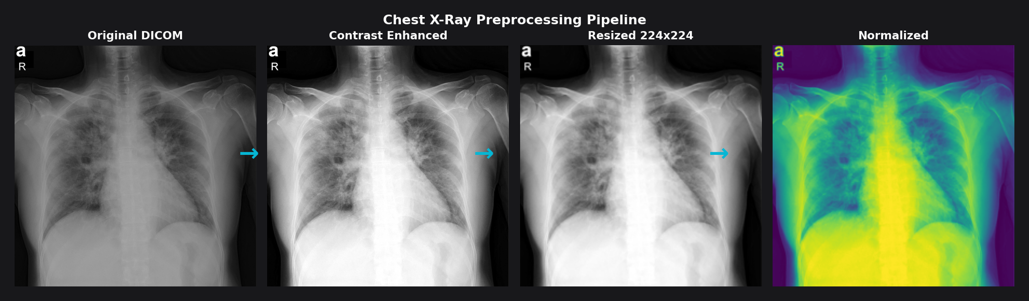 Chest X-Ray Preprocessing Pipeline: Original DICOM to Contrast Enhanced to Resized 224x224 to Normalized